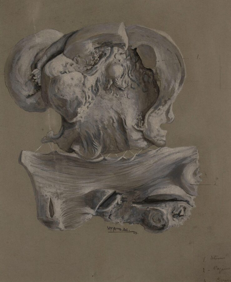 A detailed 1903 anatomical illustration in shades of gray depicting a fibroid tumor of the uterus, with labeled structures and organic textures drawn on brown paper.