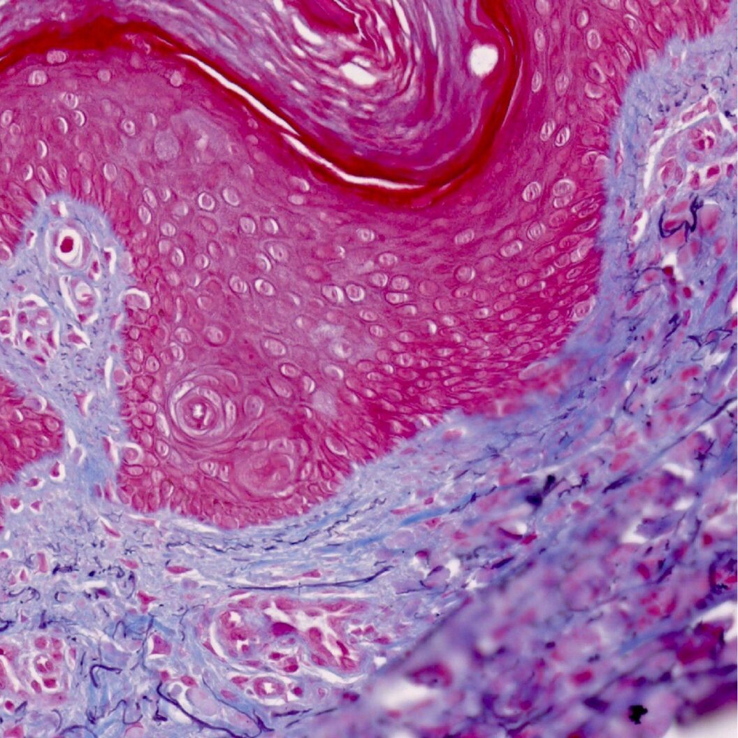 A highly magnified microscopy image of a dermatofibroma, showing swirling pink and purple cellular structures in dense layers.